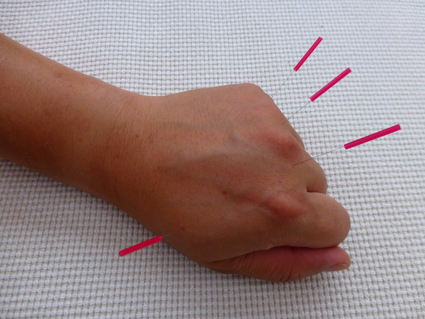 Acupuncture