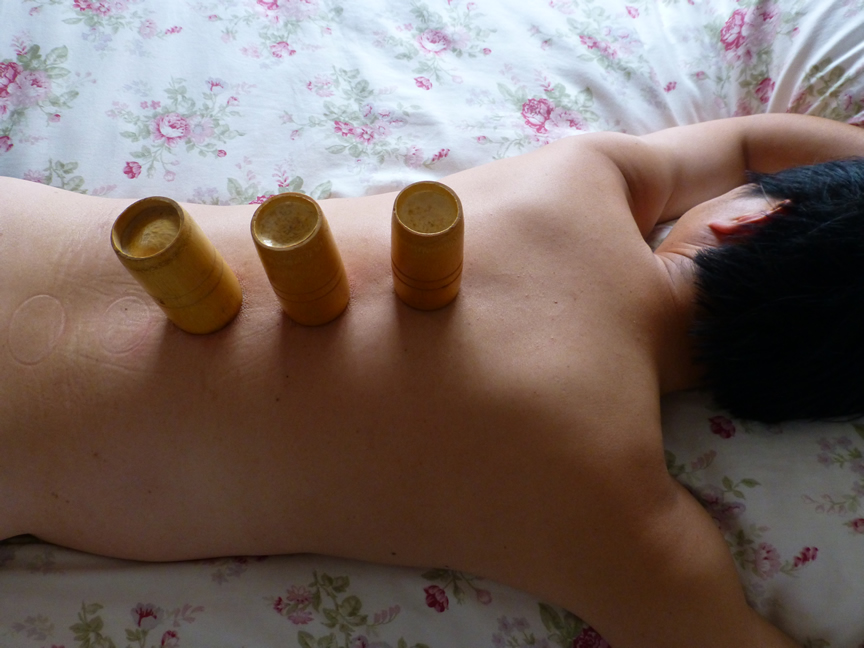 Cupping